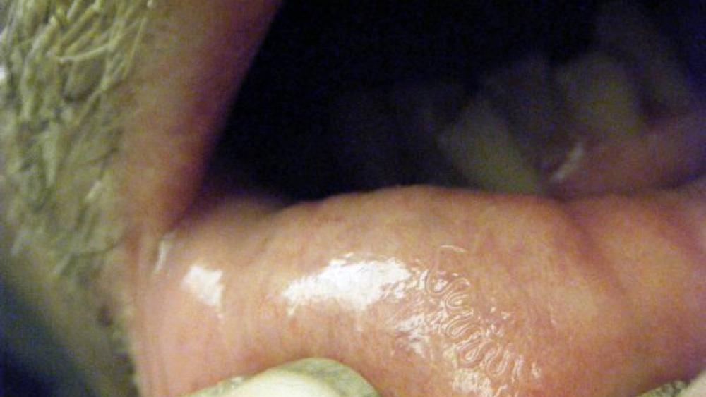On peut distinguer le ver dans la lèvre du patient. Le parasite se trouve habituellement chez les bovins. 